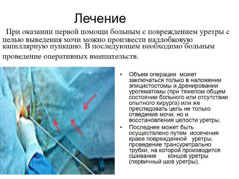 Лечение   При оказании первой помощи больным с повреждением уретры с целью выведения